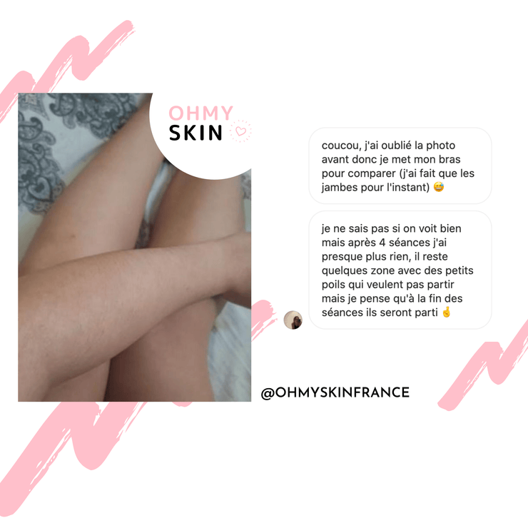 Ohmyskin épilateur à lumière pulsée