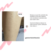 Ohmyskin épilateur à lumière pulsée